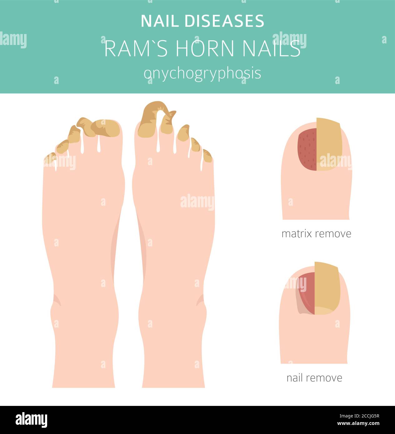 Nail diseases. Onychogryphosis, Ram`s horn nail. Medical infographic